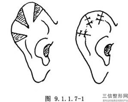 大连大学附属医院价格表(费用)2024反馈-整形修复耳朵案例