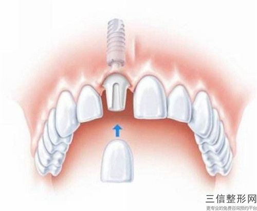 梅州大埔县城汪宝裕牙科岩上分店价格(费用)清单靠谱大全一览-门牙牙缝大补救案例